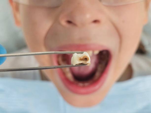 Best Emergency Dentist for Knocked-Out Tooth in Spring Grove, IL